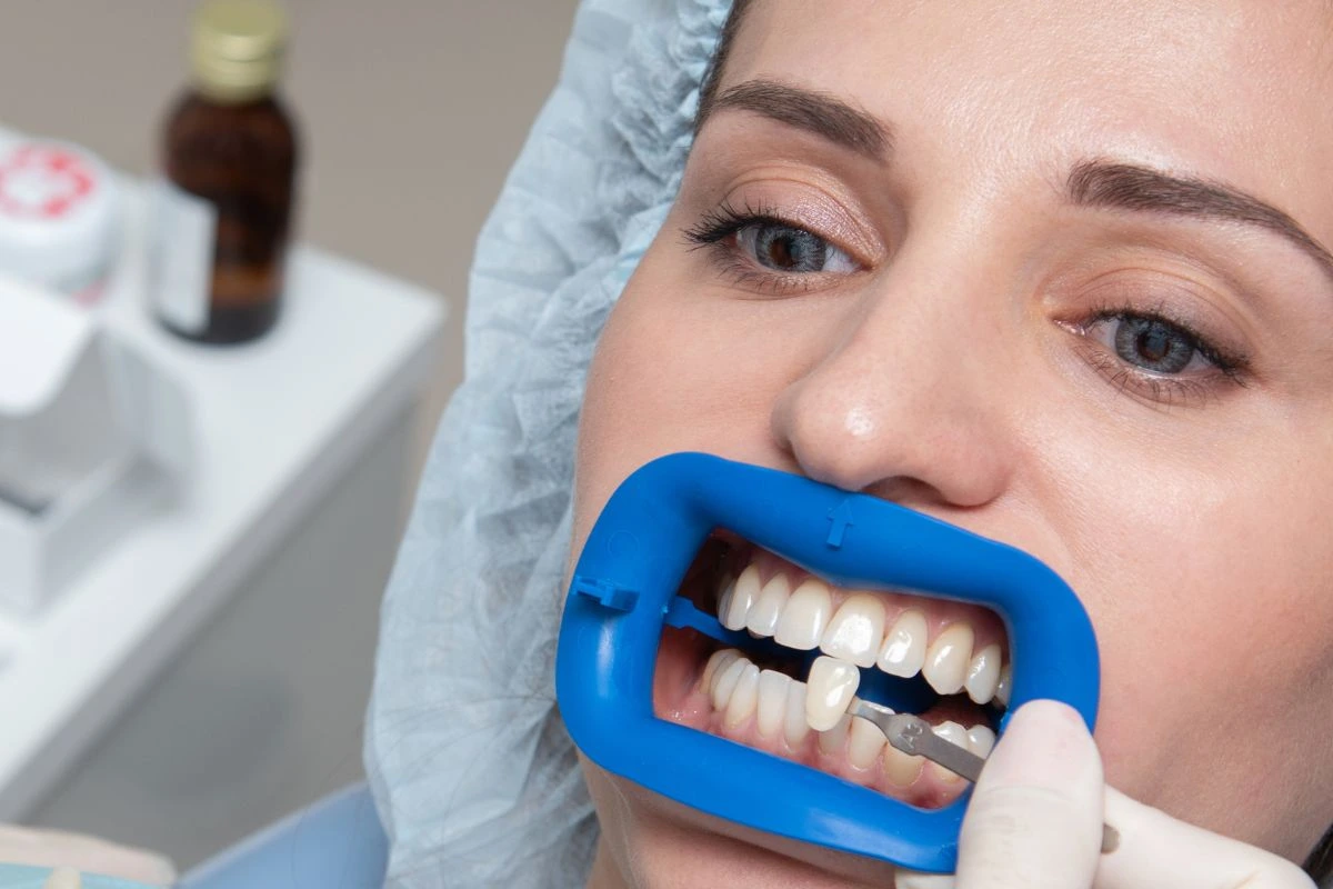 Dental Bonding Vs Veneers