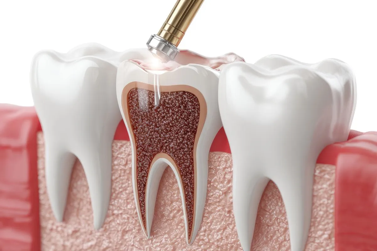Dental Bonding