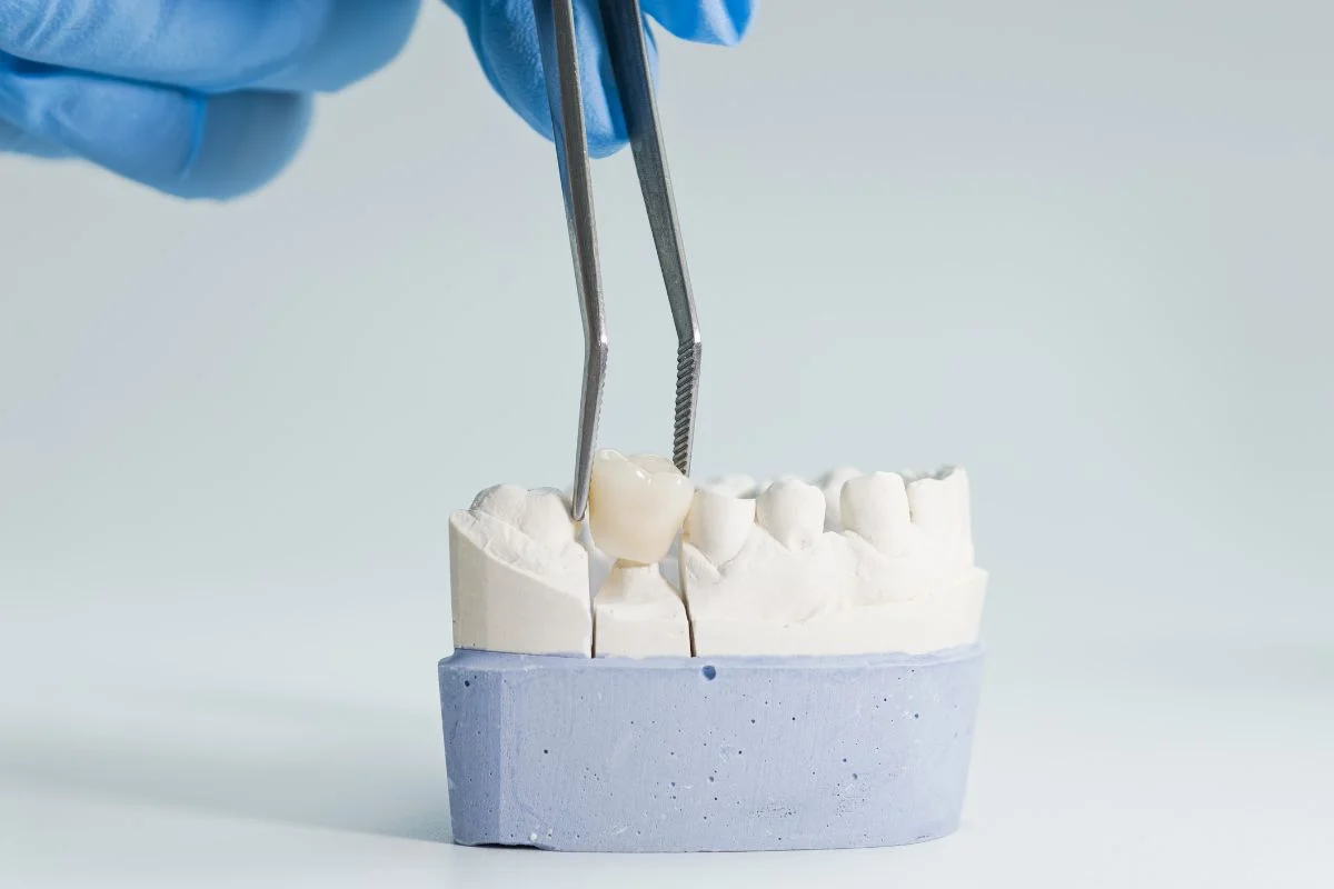 Dental Crowns in North York