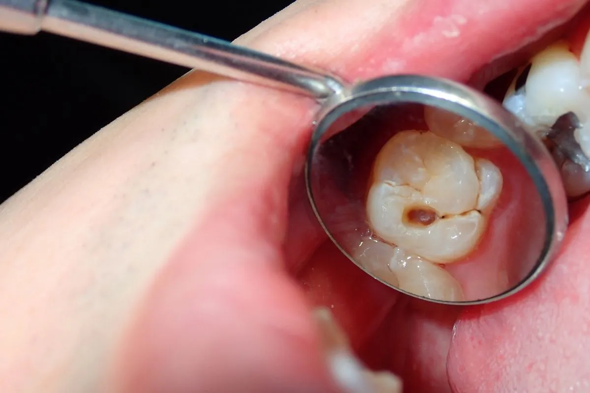 Dental Fillings in North York