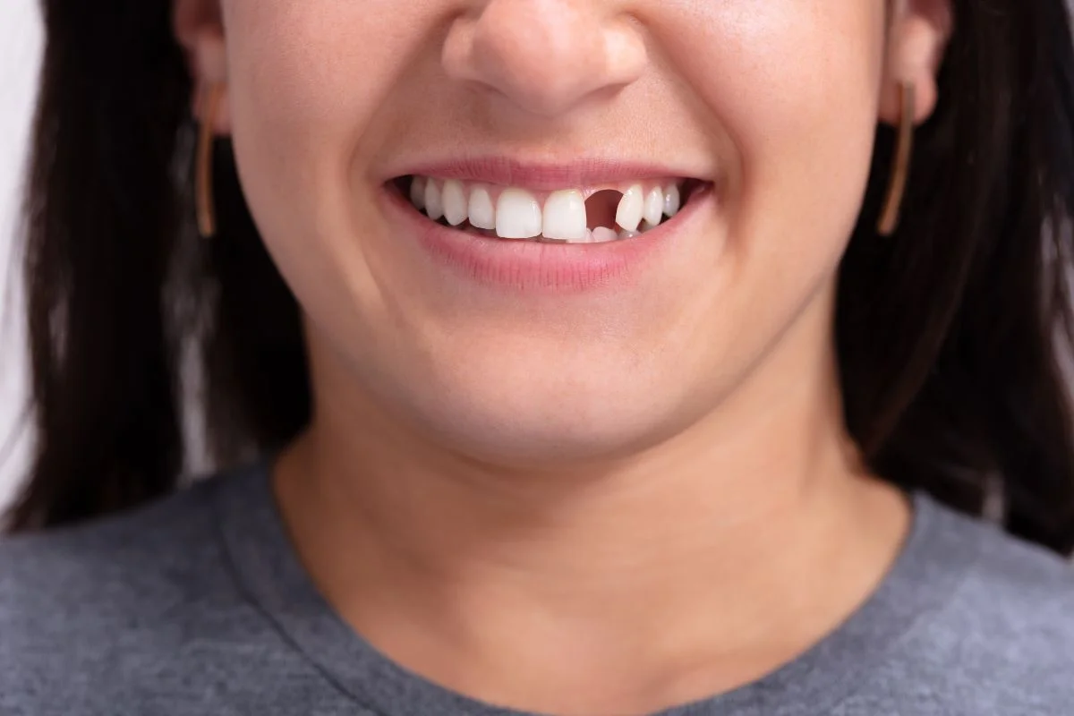 Dental Implant, Bridge Or Partial Denture