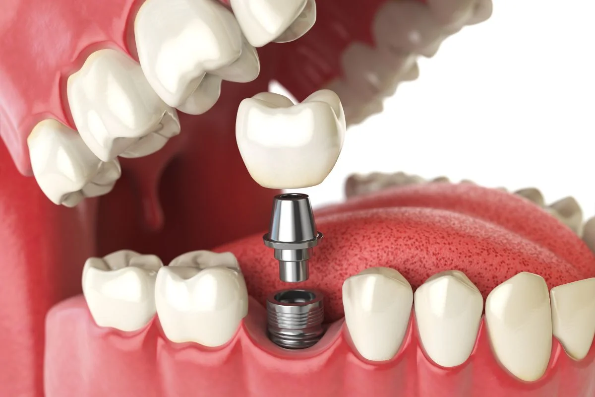 Dental Implant Vs Bridge