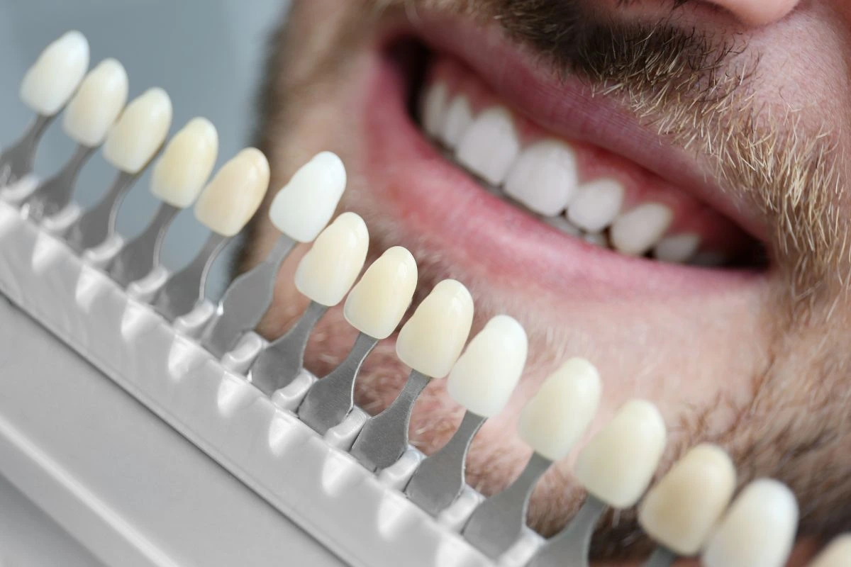 Do Veneers Require Removing Enamel