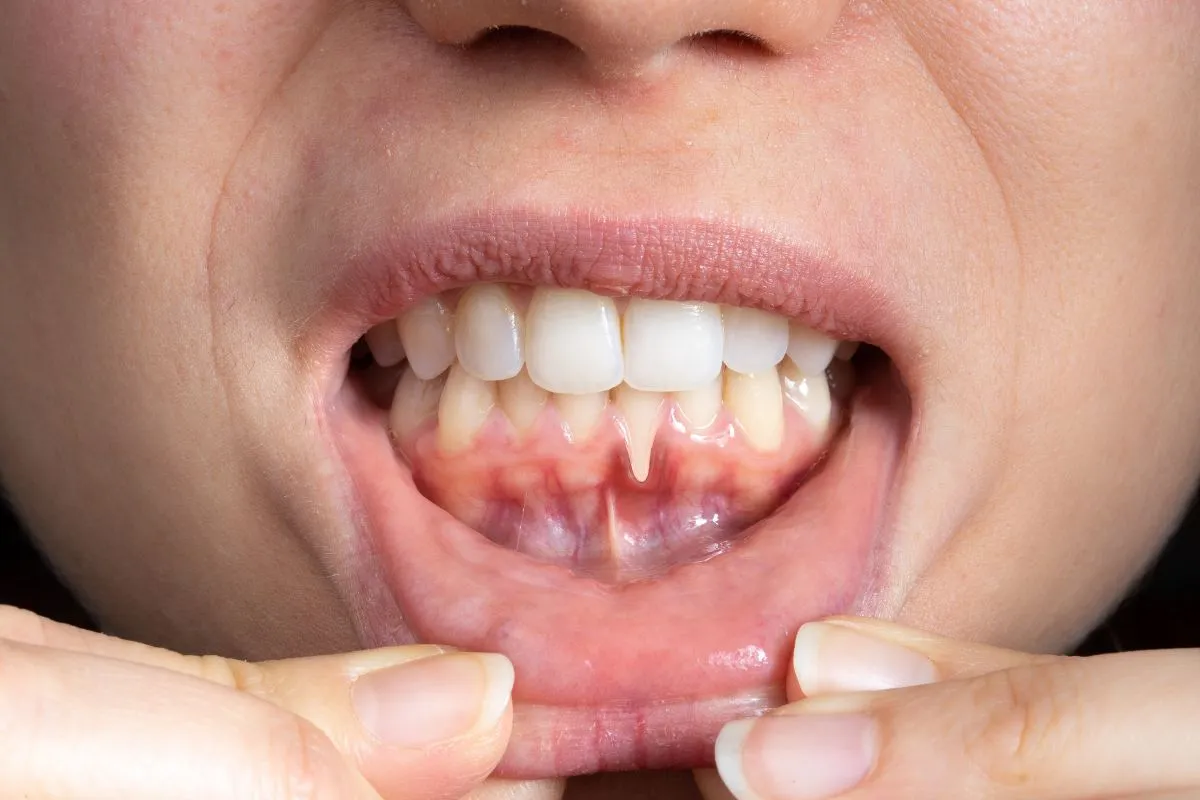 Gum Disease Treatment