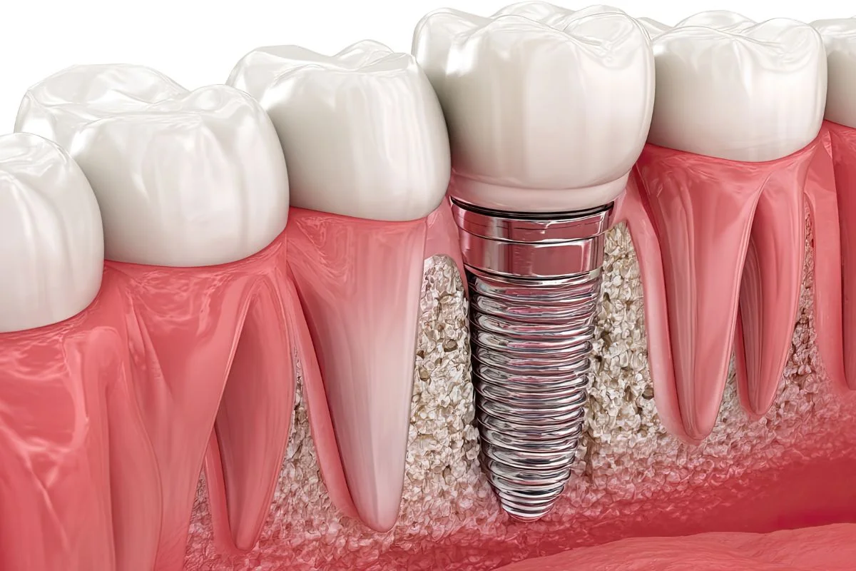 How A Dental Implant Replaces A Tooth