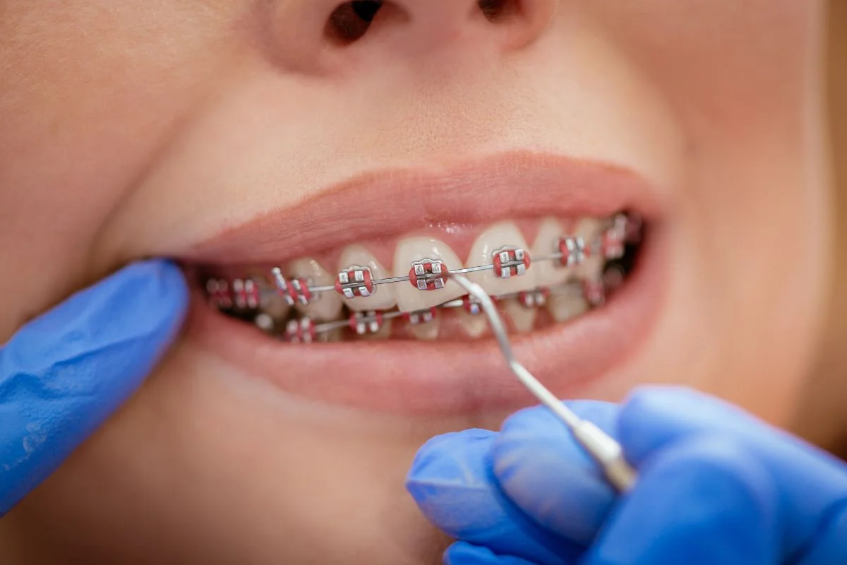 How Braces Work