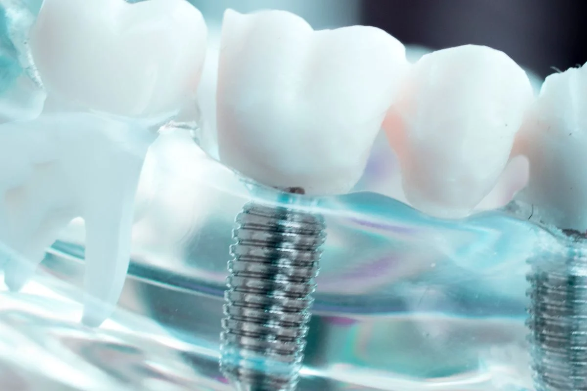 How Does A Dental Bridge Work