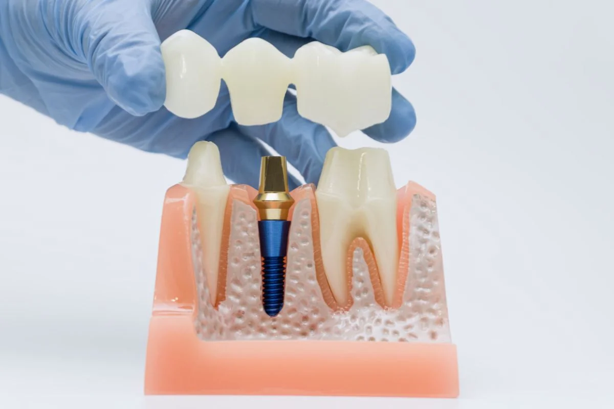 Implant Vs Bridge