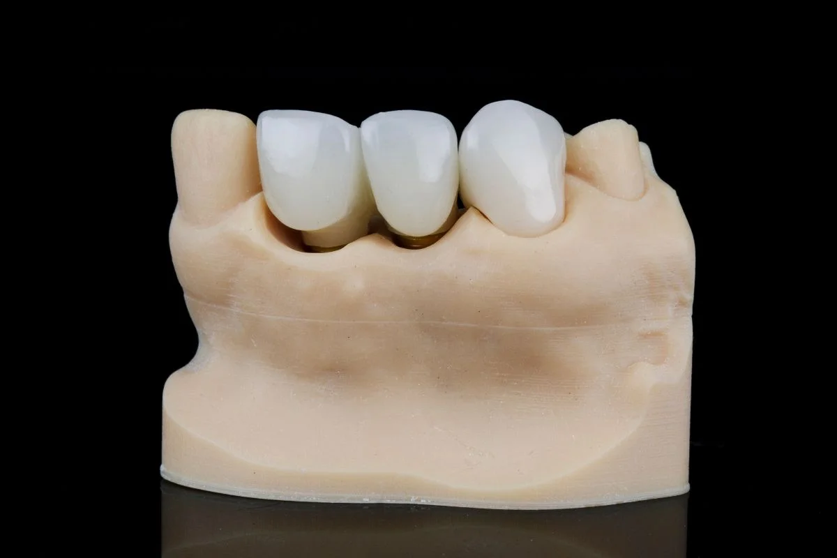 Implant Vs Bridge Vs Denture
