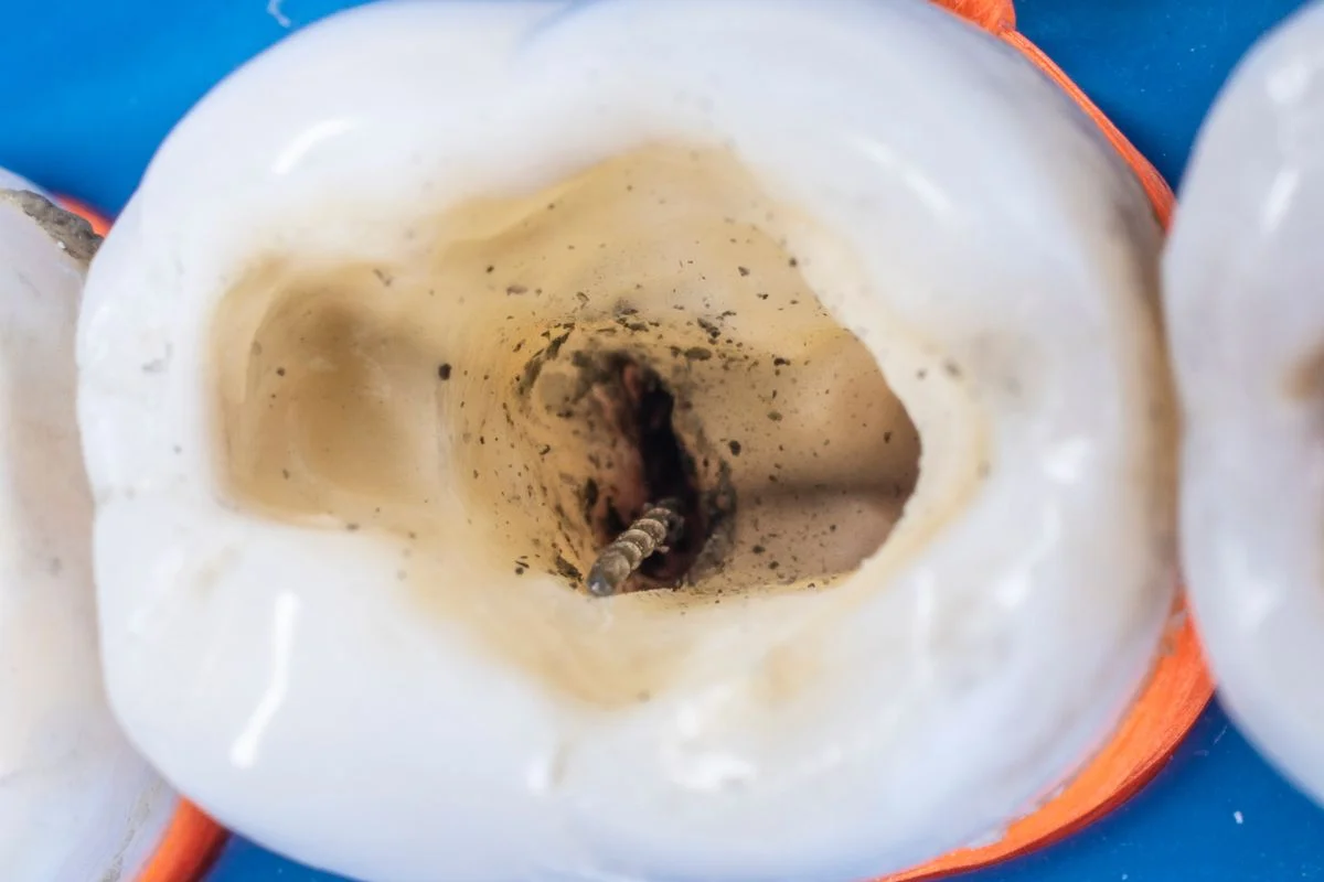 Is It Better To Have A Root Canal Or Extraction