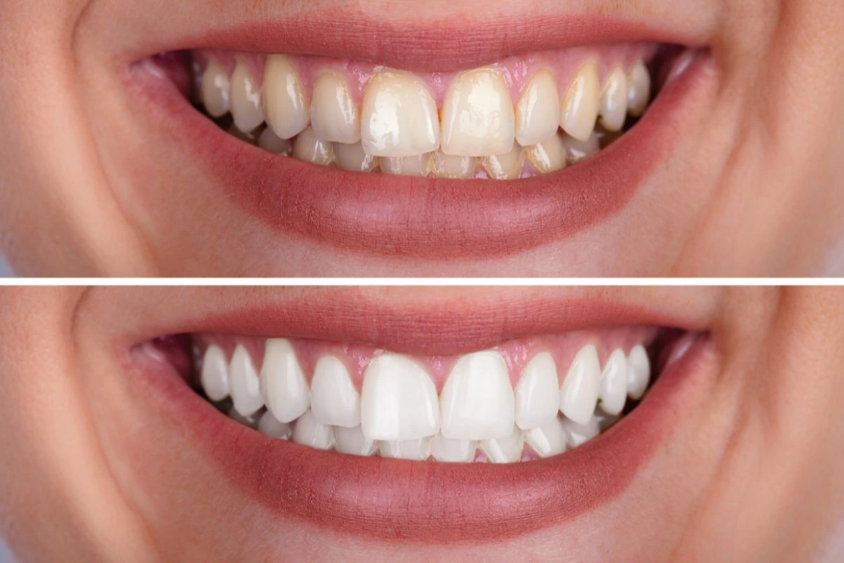 Professional Teeth Whitening