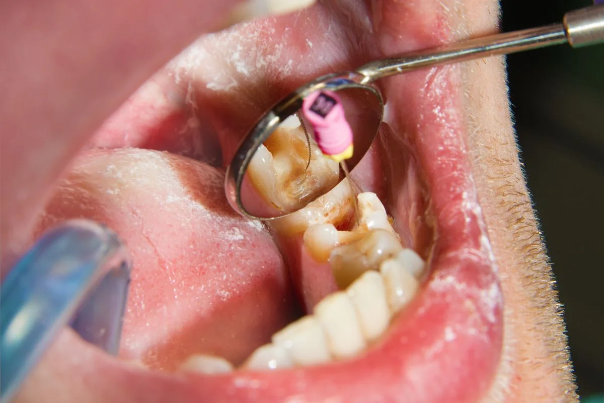 Root Canal Vs Tooth Extraction