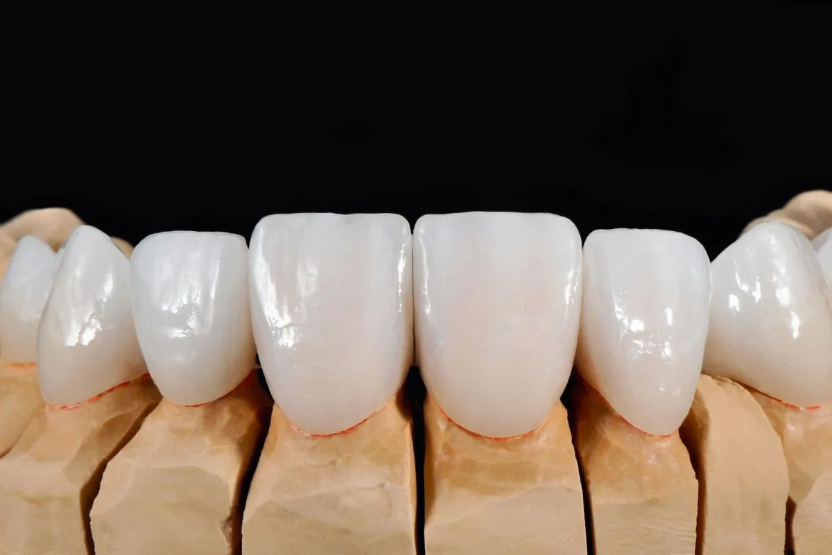 What Can Veneers Improve