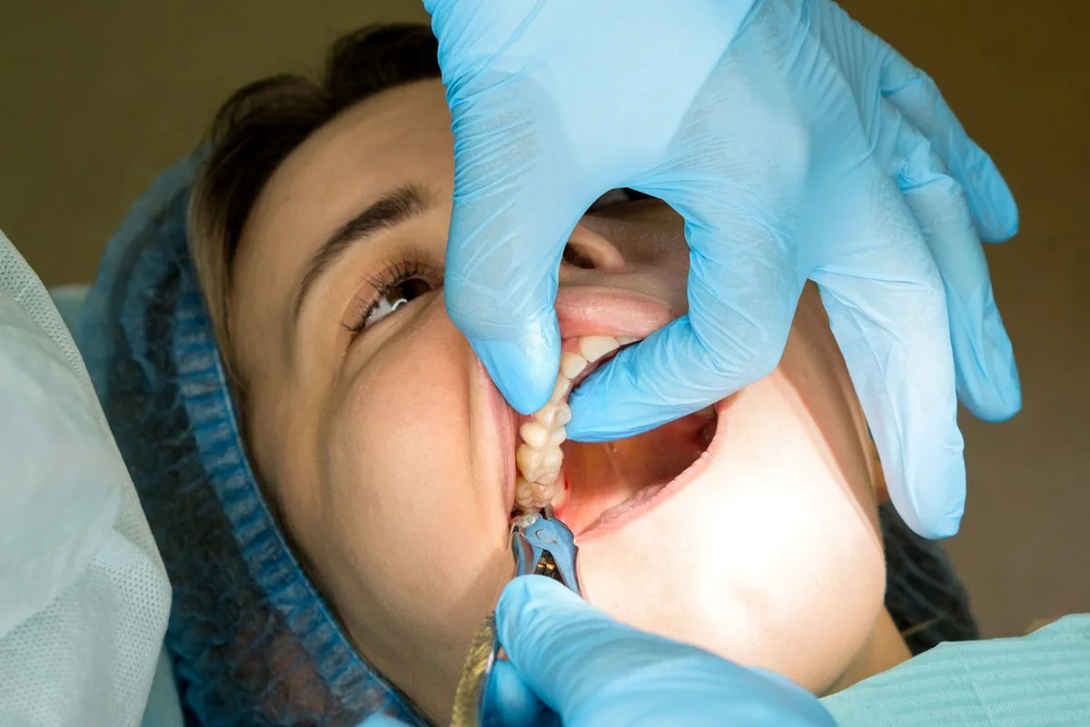 Wisdom Teeth Removal in North York