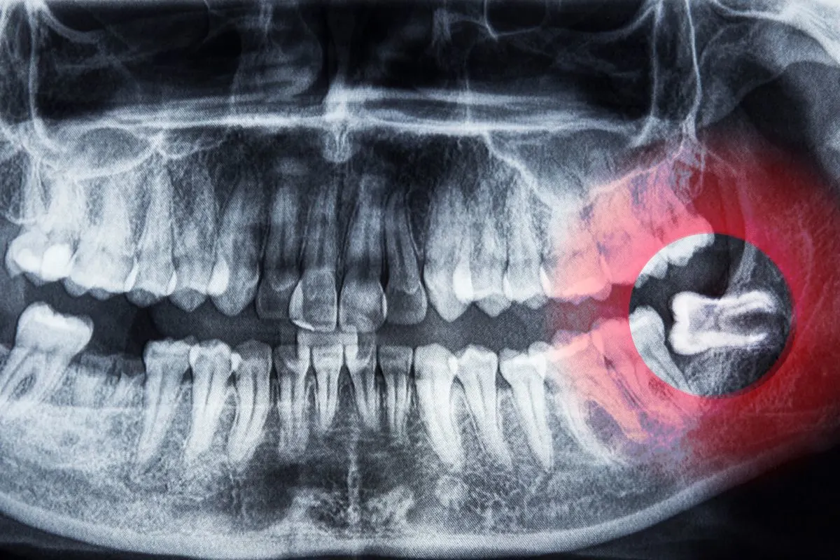 Wisdom Teeth Removal